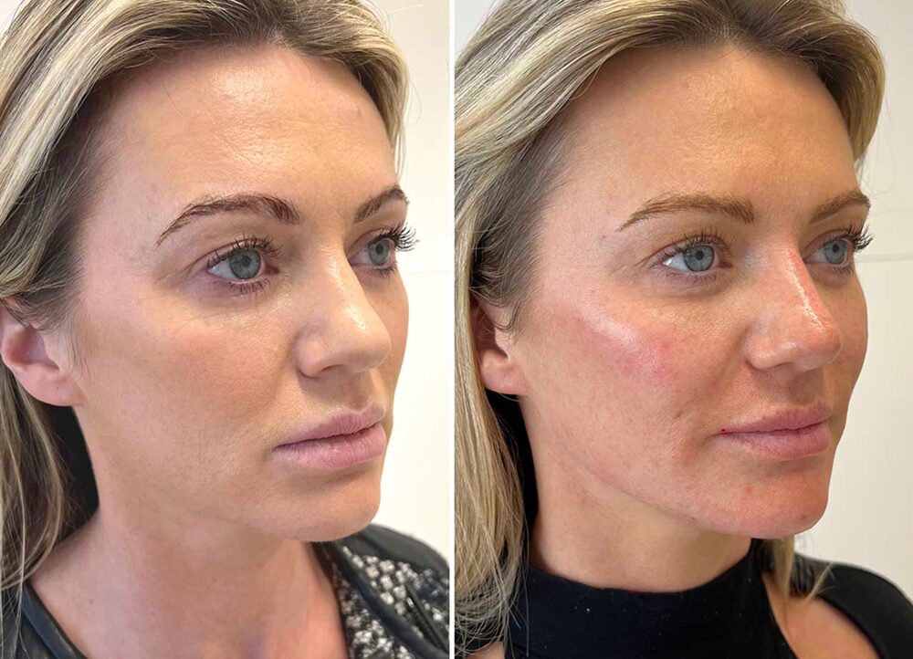 ba-full-face-rejuvenation-1 1
