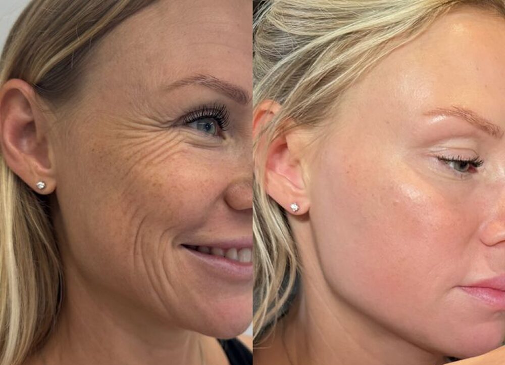 Botox magic 1
