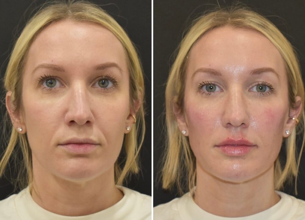 fullfacerejuvenationleeds 1
