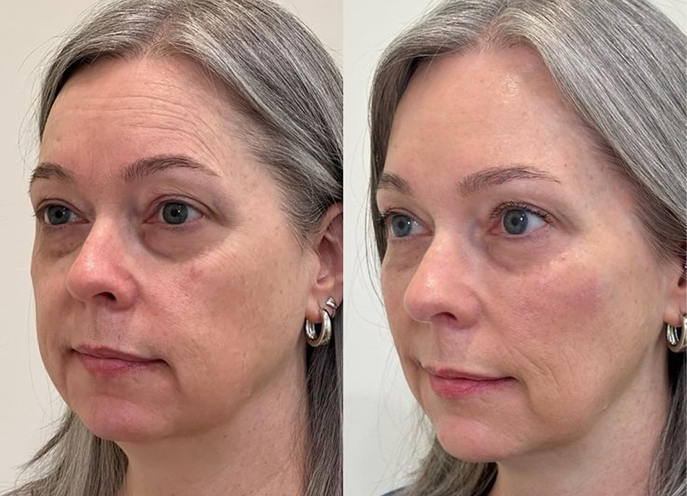 The power of facial balancing — strategically placing tox and filler to brighten and rejuvenate 😍 Beautiful before and beautiful after, just with some small tweaks 👏__💉@laurenzirgibel_pa_📍Tallahassee, F 1